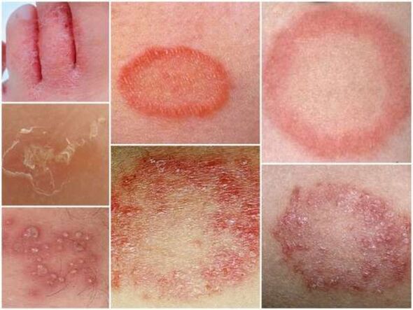 Kāju ādas trihofitoze