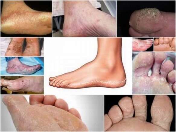 Pēdu mikozes plakanšūna-hiperkeratotiska forma