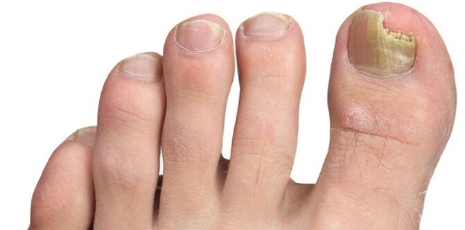 nagu plāksnes sēnīšu infekcija