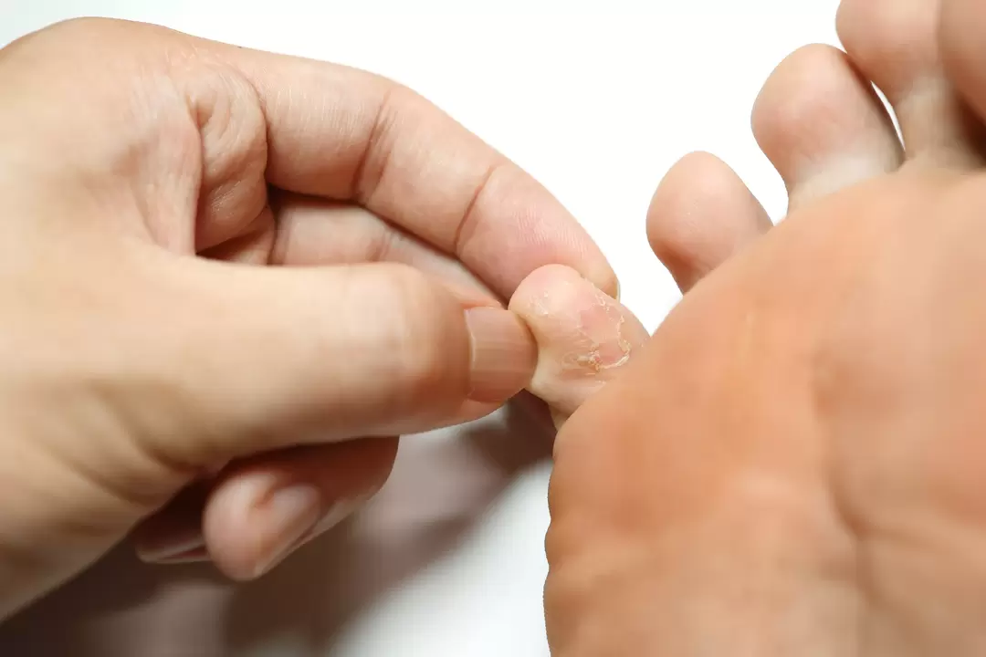 sēne uz pirkstiem un tā apstrāde ar zxcvbnmqwert krēmu ar krējumu